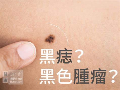 臉部黑痣|不大驚小怪！如何辨別「黑痣」與「黑色腫瘤」？ 